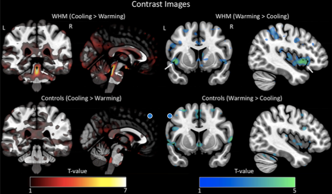 Activation of Hof's brain (top) and the control group during cooling (left) and in a normal state (right).