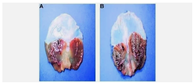 Calcified epiphysis.